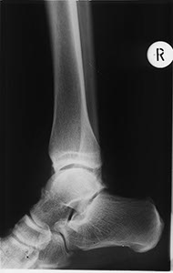 %_tempFileNamex_ray_heel%